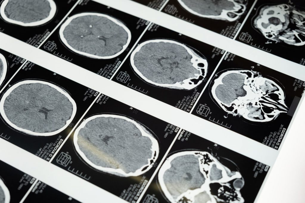 Concussion in Football