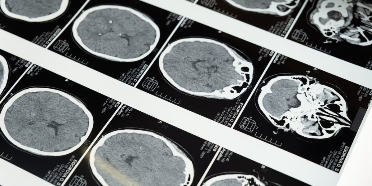 Concussion in Football
