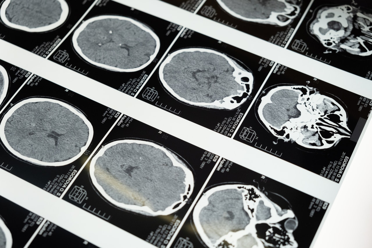 Concussion in Football